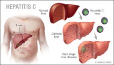 Hepatitis C Graphic