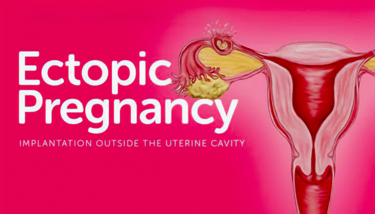 Ectopic Pregnancy news graphic